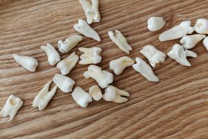 Pain-Free Root Canal Treatment 1
