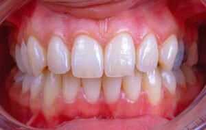 Prevent Gum Disease