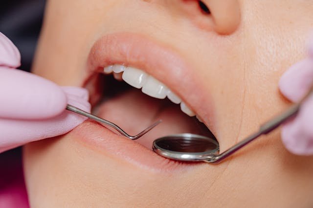 composite bonding